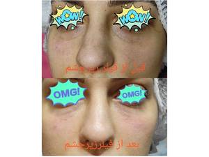 هزینه تزرق ژل زیر چشم
