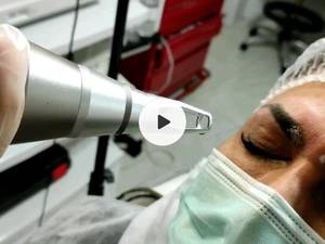 حذف تتوی ابرو