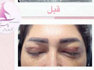 جراحی پلک یا بلفاروپلاستی