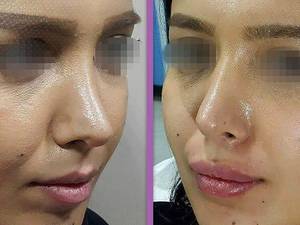 انجام تزریق ژل لب