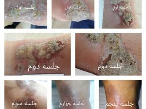 خانم ۳۰ ساله با بیماری پوستی پسوریازیس