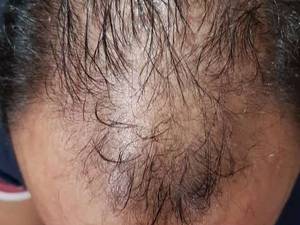 کاشت مو به  روش میکرو اسکالپ سردر تهران