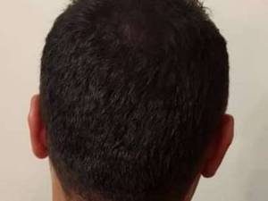 کاشت مو به  روش میکرواسکالپ سر درتهران