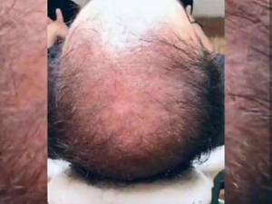 آموزش و خدمات میکرواسکالپ در مازندران