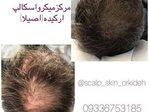میکرو اسکالپ حرفه ای در مازندران