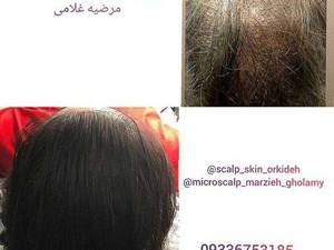 میکرو اسکالپ حرفه ای در مازندران