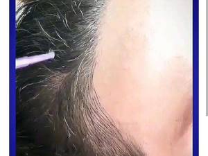 میکرو اسکالپ حرفه ای در مازندران