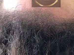 میکرو اسکالپ حرفه ای در مازندران