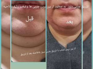 رفع غبغب با روش مزوتراپی چربی سوز