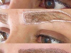 اجرای میکروبلیدینگ تلفیقی در رشت