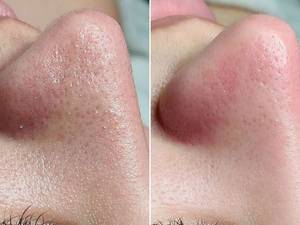 انجام پاکسازی و فیشیال بینی