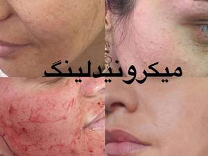 انجام فیشیال تخصصی پوست در فارس