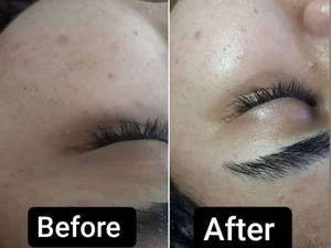 پاکسازی پوست چرب و جوشدار