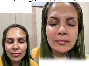 لیفت و جوانسازی صورت بدون عمل دربوشهر