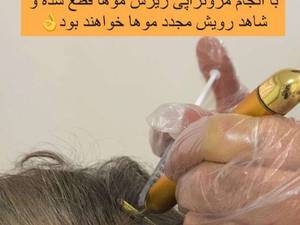 مزو تراپی تخصصی   مو در اصفهان