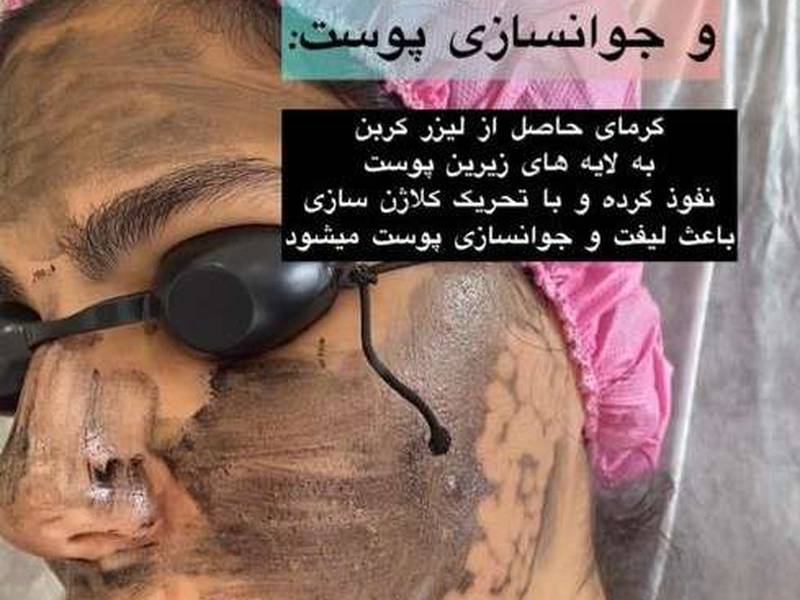مرکز تخصصی کربن تراپی پوست در اصفهان