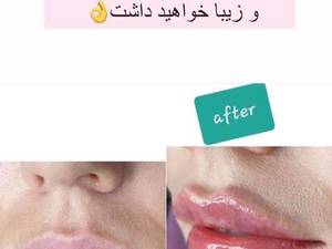 تزریق  ژل نورامیس با متد روسی در اصفهان