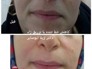 کاهش خط خنده با تزریق ژل