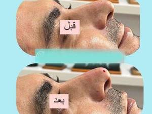 اصلاح فرم بینی با تزریق فیلر