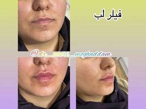 تزریق تخصصی فیلر لب  در لاهیجان