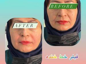 تزریق فیلر خط خنده
