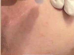 میکرودرم ابریژن در لاهیجان