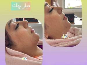 تزریق فیلر چانه در لاهیجان