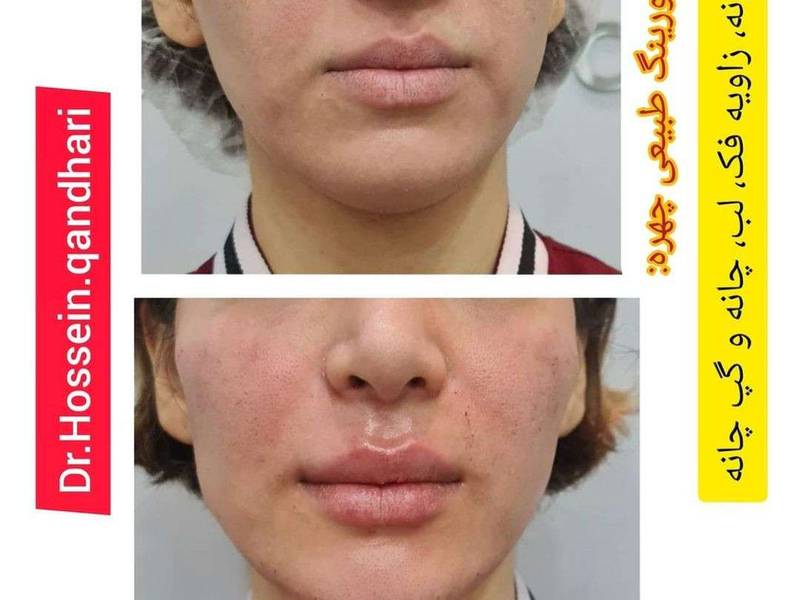مدلینگ و زاویه سازی صورت با فیلر