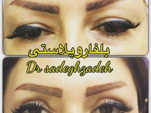 بلفاروپلاستی