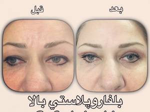 بلفاروپلاستی