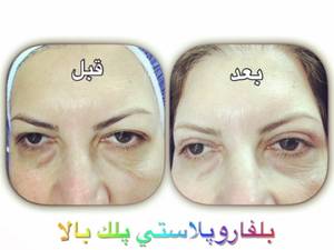 بلفاروپلاستی