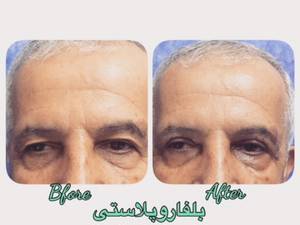 بلفاروپلاستی