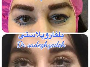 بلفاروپلاستی