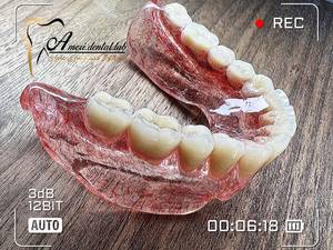 پروتز فک پایین مدل و طرح شیشه ای