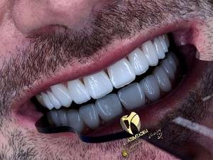اصلاح فرم و سایز دندان ها با کامپوزیت زیبایی