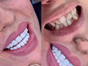 اصلاح فرم و رنگ دندان های به هم ریخته