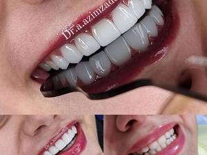 اصلاح فرم و رنگ دندان های به هم ریخته