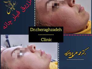 فیلر چانه