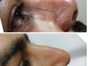 لیفت ورفع قوزبینی بدون عمل