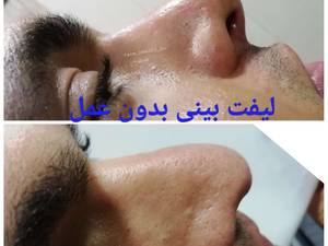 لیفت بینی بدون عمل