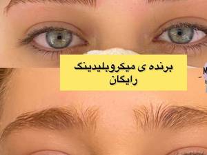 میکروبلیدینگ کرکی مویی رایگان