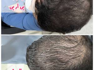 پی آر پی  مو