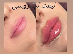 تزریق لیفت لب روسی