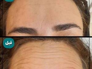 تزریق و بوتاکس خط پیشانی