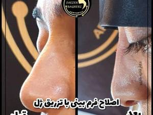 اصلاح فرم بینی با تزریق ژل