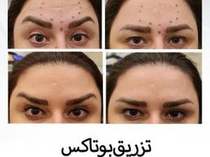 تزریق بوتاکس 