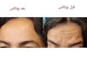 تزریق بوتاکس 