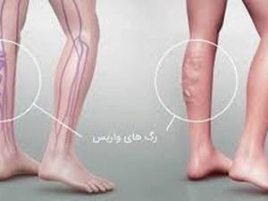 رفع واریس