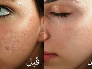 مزونیدلینگ