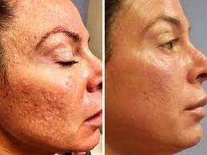 میکرونیدلینگ با استفاده از دستگاه مخصوص